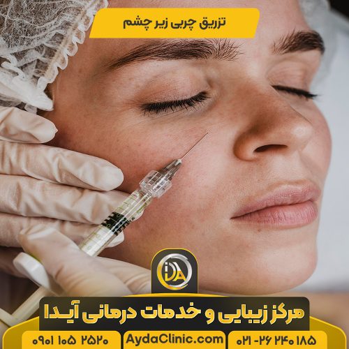 تزریق چربی زیر چشم در تهران